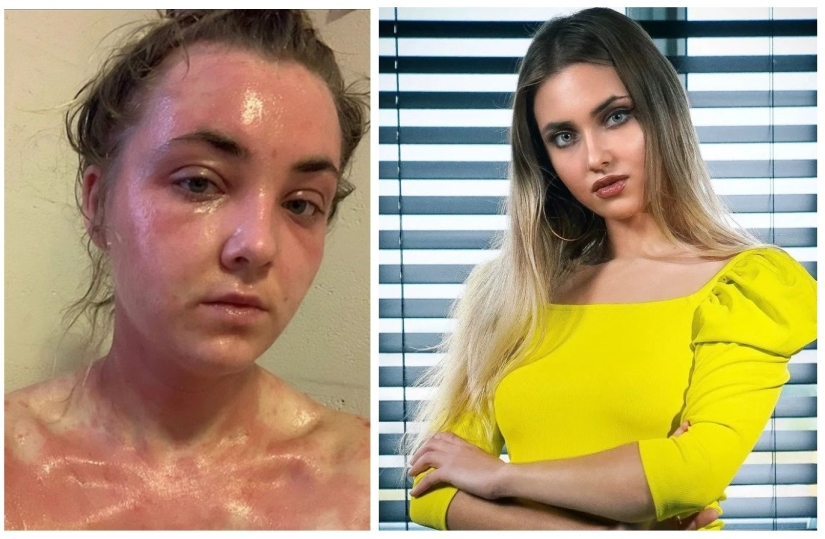 Clean food - clean skin: model cured of eczema by becoming a vegetarian