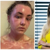 Clean food - clean skin: model cured of eczema by becoming a vegetarian