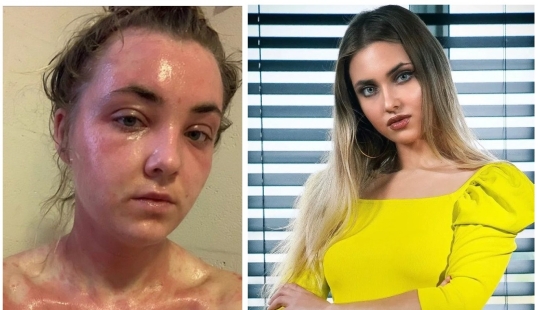 Clean food - clean skin: model cured of eczema by becoming a vegetarian Clean food - clean skin: model cured of eczema by becoming a vegetarian