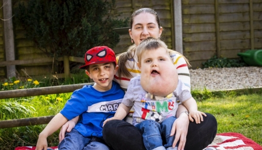 Con fe en lo mejor: un niño de 4 años con un tumor en la cara no pierde el corazón, a pesar de la enfermedad Con fe en lo mejor: un niño de 4 años con un tumor en la cara no pierde el corazón, a pesar de la enfermedad