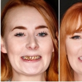 Con una sonrisa para toda la vida: cómo una chica se transformó con dientes terribles