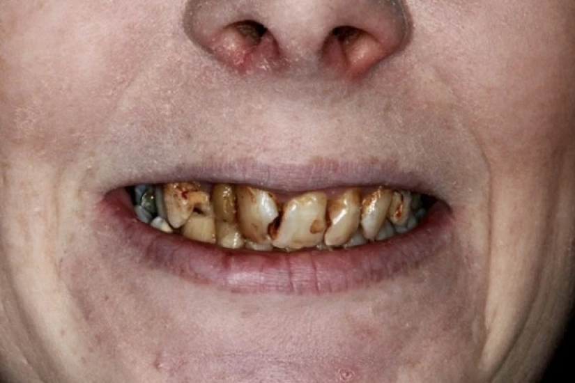 Con una sonrisa para toda la vida: cómo una chica se transformó con dientes terribles