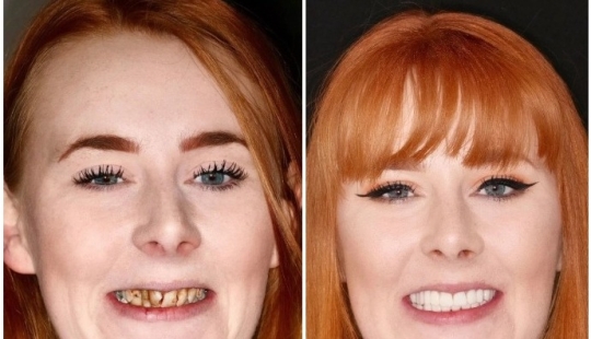 Con una sonrisa para toda la vida: cómo una chica se transformó con dientes terribles