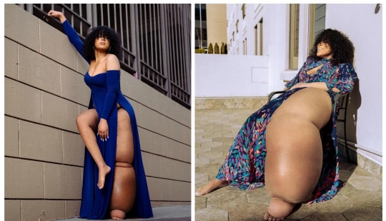 "Cortar la pierna!": how an American woman with a 45-kilogram limb learned to love herself