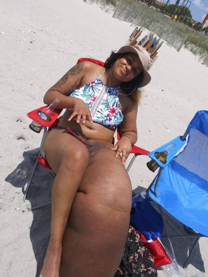 "Cut off your leg!": how an American woman with a 45-kilogram limb learned to love herself