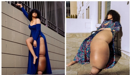 "Cut off your leg!": how an American woman with a 45-kilogram limb learned to love herself