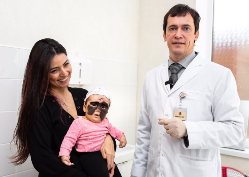 De Batman a Princesa: los médicos rusos eliminaron una enorme marca de nacimiento de la cara de una mujer estadounidense de 2 años