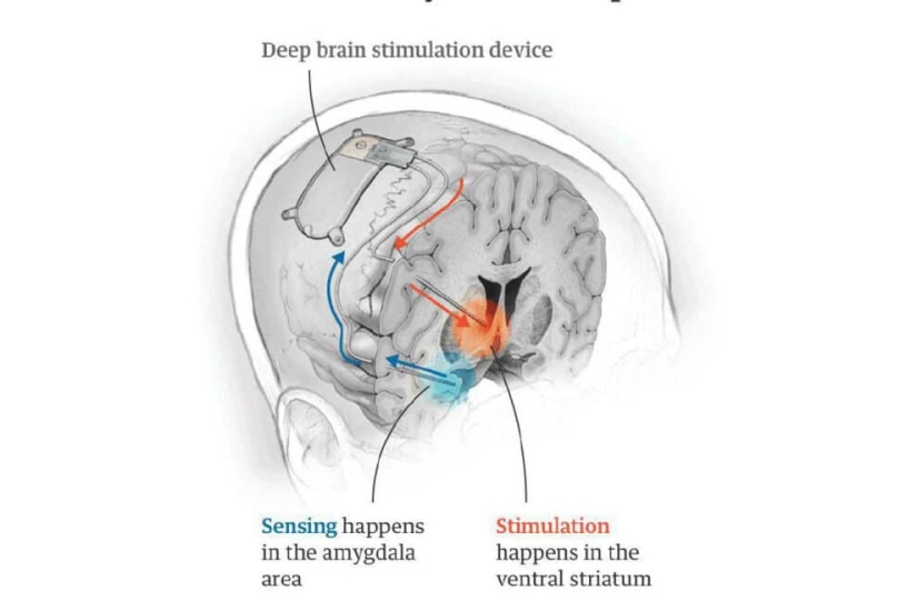 Doctors from the USA cured depression for the first time by implanting an implant in the human brain