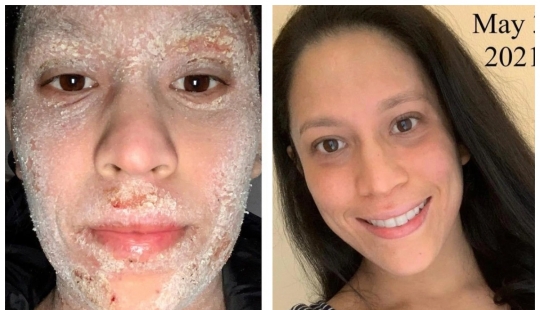 Efecto secundario: una mujer estadounidense ha soportado un sufrimiento terrible debido a los esteroides para tratar el eccema