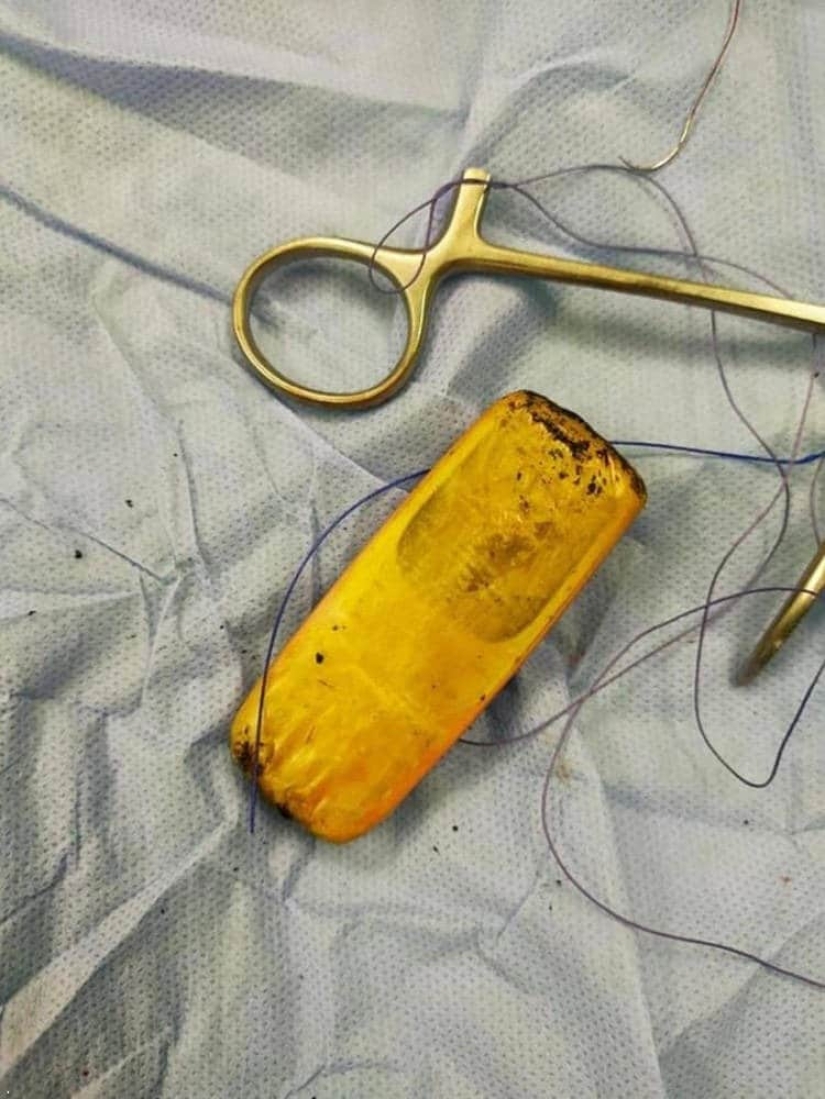 Egyptian doctors took out a mobile phone from the patient's intestines, which had been there for six months