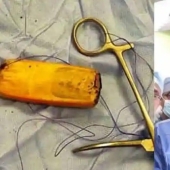Egyptian doctors took out a mobile phone from the patient's intestines, which had been there for six months
