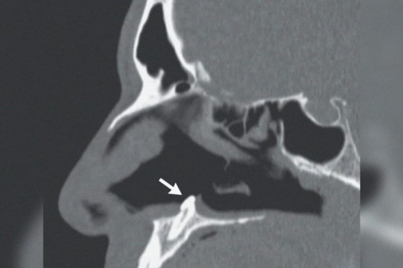 En los EE.UU., los cirujanos extirparon un diente que creció en la nariz de un hombre