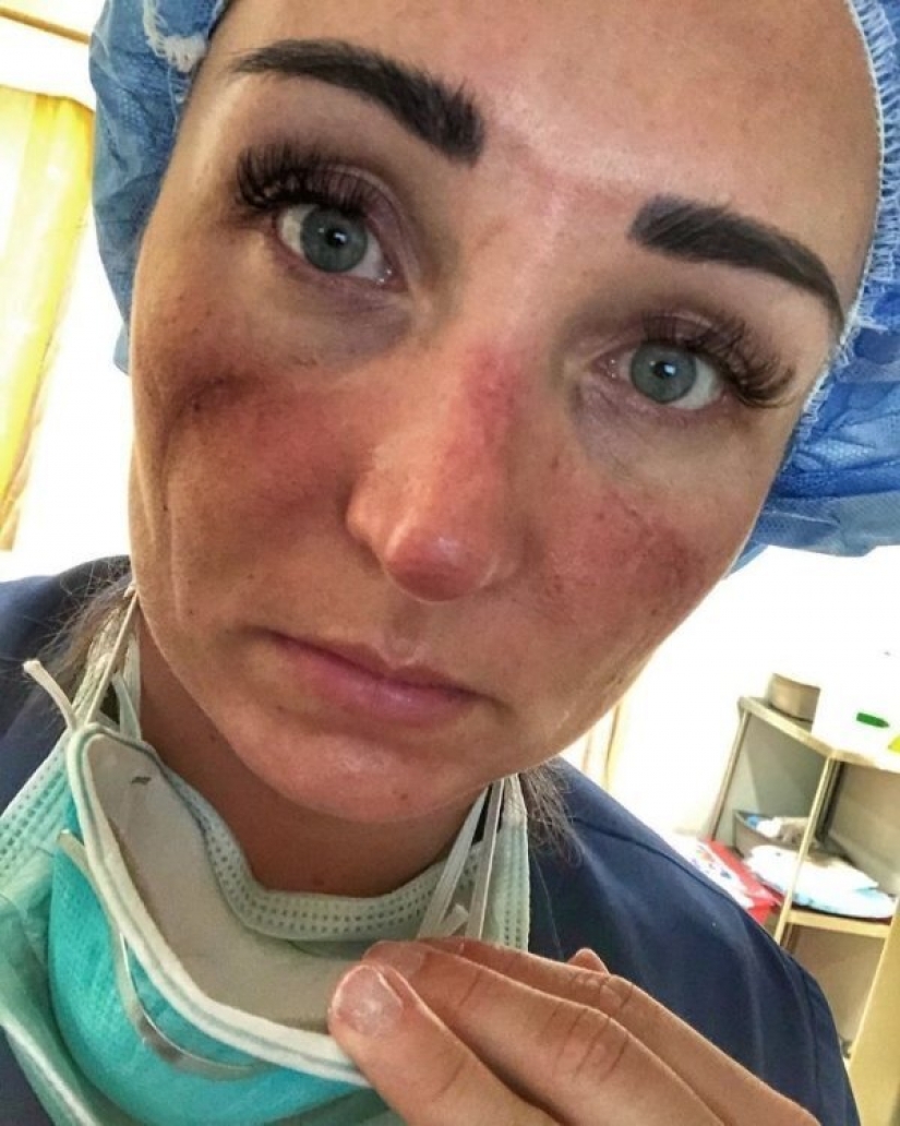 "Estas heridas no desaparecerán, permanecerán dentro de nosotros": fotos de chicas médicas con rastros de máscaras en sus rostros