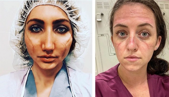 "Estas heridas no desaparecerán, permanecerán dentro de nosotros": fotos de chicas médicas con rastros de máscaras en sus rostros "Estas heridas no desaparecerán, permanecerán dentro de nosotros": fotos de chicas médicas con rastros de máscaras en sus rostros