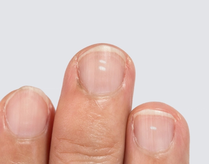 From arthritis to melanoma: 10 signs of serious diseases that can be identified by nails