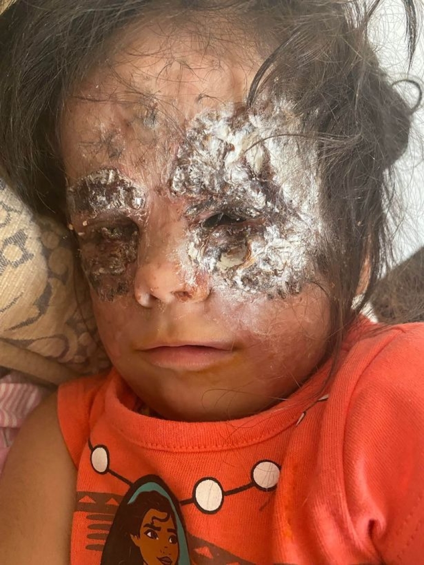 From Batman to Princess: Russian doctors removed a huge birthmark from the face of a 2-year-old American woman