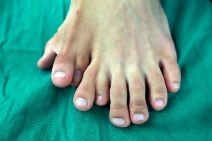 Happiness is never too much: the Chinese have long lived with 14 toes, considering the anomaly of happy sign