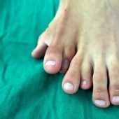 Happiness is never too much: the Chinese have long lived with 14 toes, considering the anomaly of happy sign