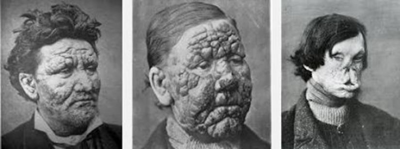 History of leprosy: why humanity has conquered, but not defeated "lazy death"