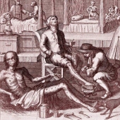 How venereal diseases were treated in the old days: lead weights, a whip and mercury ointments