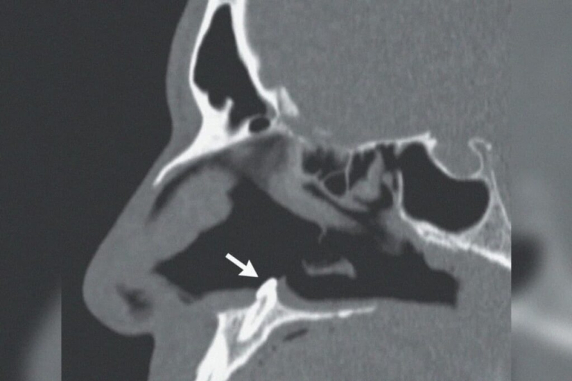 In the USA, surgeons removed a tooth that grew in a man's nose