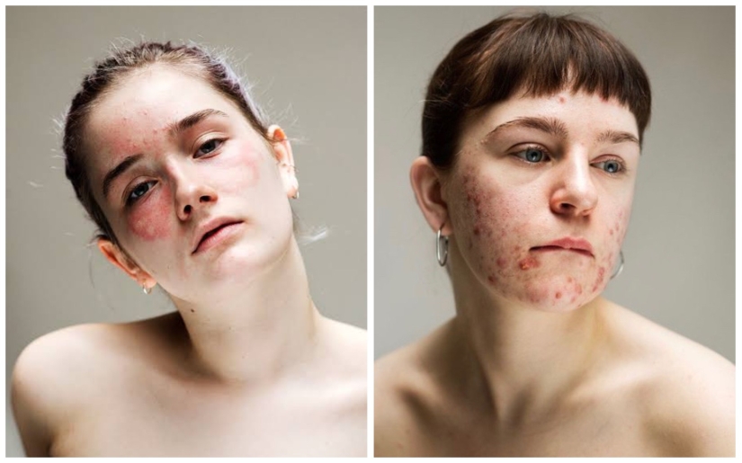 In your skin: a powerful photo project "Epidermis" by Sophie Harris-Taylor