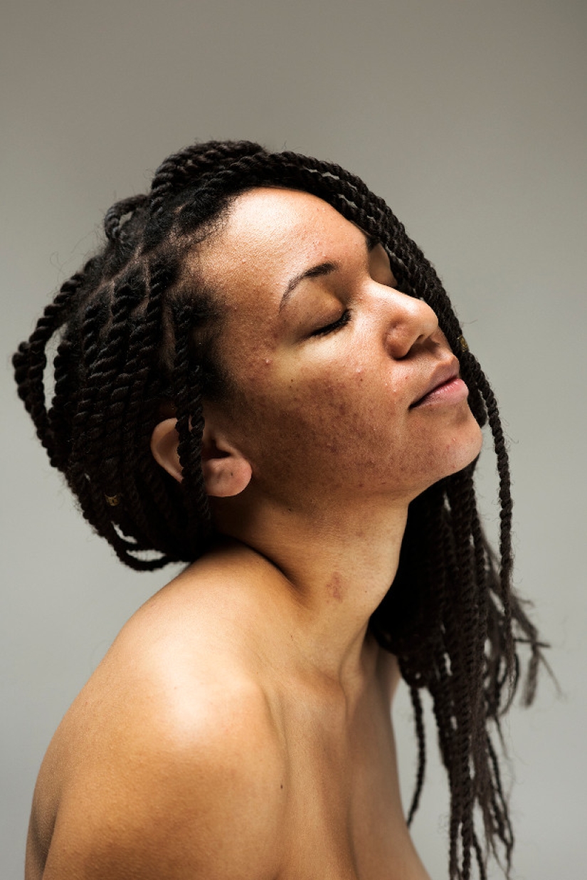 In your skin: un potente proyecto fotográfico "Epidermis" de Sophie Harris-Taylor