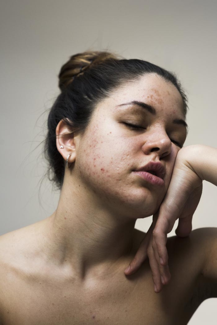 In your skin: un potente proyecto fotográfico "Epidermis" de Sophie Harris-Taylor