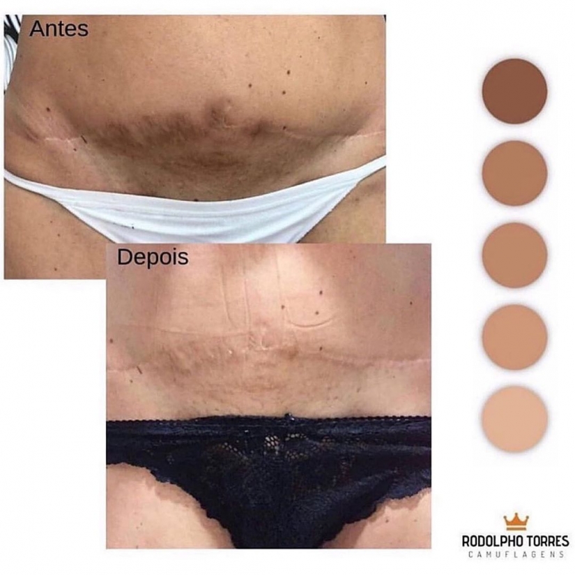 Instead of surgeons and creams: a Brazilian tattoo artist gets rid of stretch marks in an unconventional way