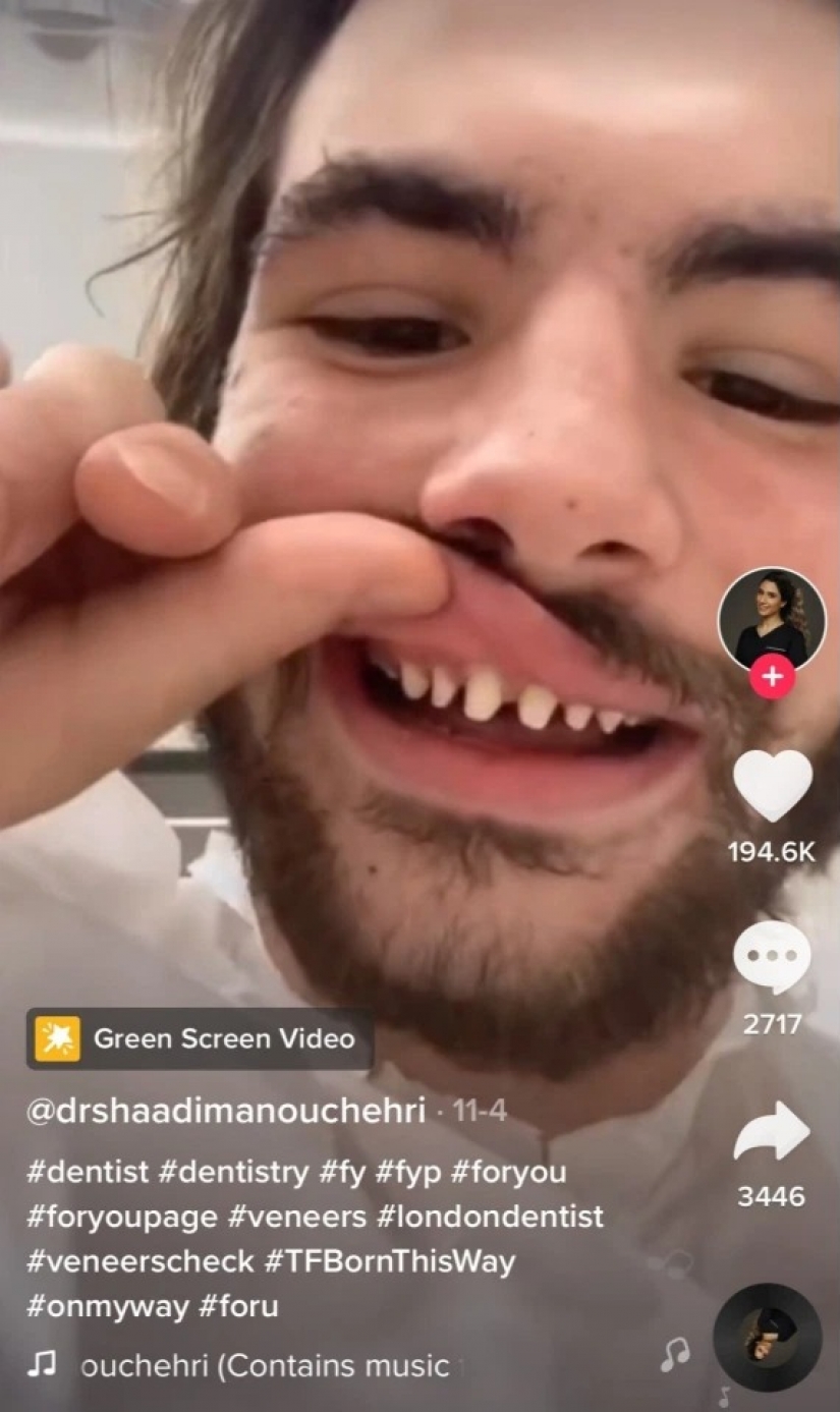 Jagged: more and more people in TikTok are addicted to a dangerous trend, risking their smile