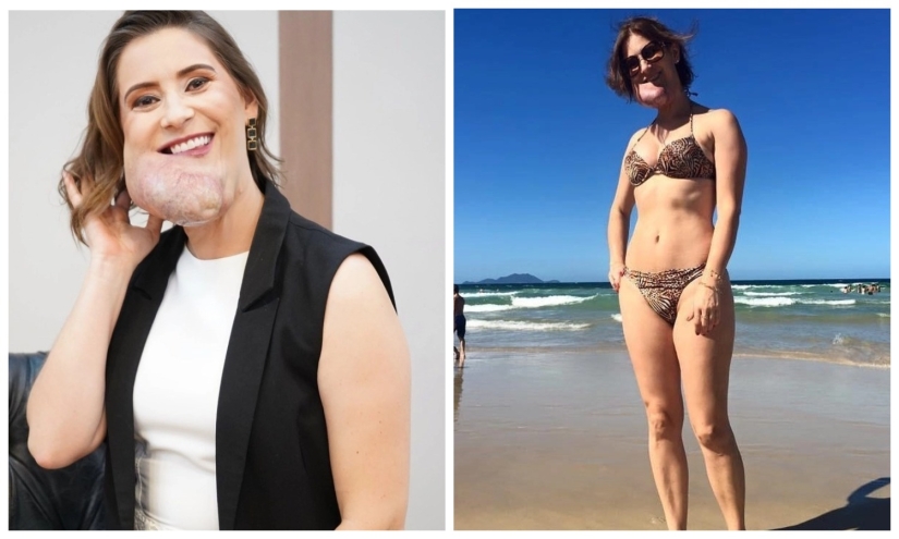 La belleza, no importa qué: una mujer Brasileña con una enfermedad rara admira la auto-confianza