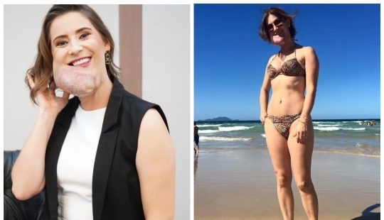 La belleza, no importa qué: una mujer Brasileña con una enfermedad rara admira la auto-confianza