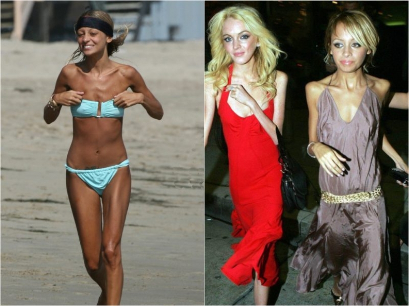 La estrella de la fiebre: el que las celebridades se enfrentan con la anorexia