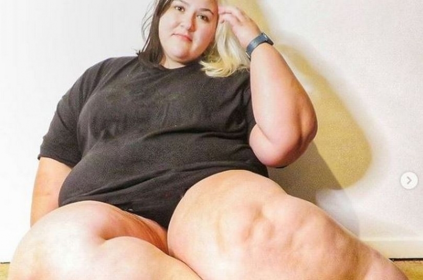 La mujer británica se agotó con dietas para hacer que sus piernas perdieran peso, pero era una enfermedad
