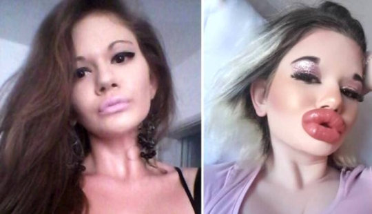 La mujer con los labios más grandes del mundo va a agrandar sus mejillas