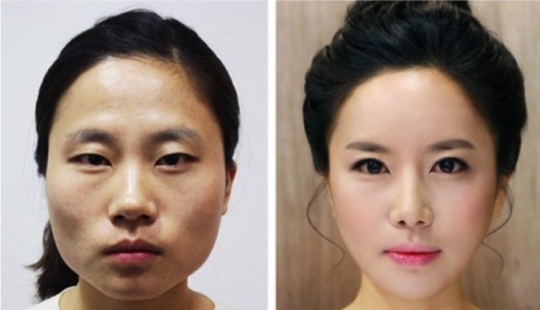 "Labios de cereza", reducción de mandíbula, fosas nasales de plástico: ¿qué operaciones son populares en Corea del Sur