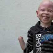 Los albinos de tanzania, cuyos cuerpos valen más que el oro