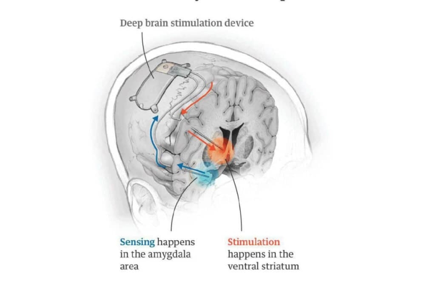 Los médicos de los EE.UU. curaron la depresión por primera vez implantando un implante en el cerebro humano