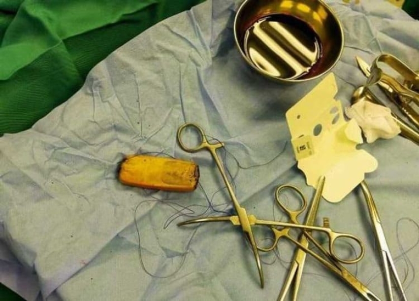 Los médicos egipcios sacaron un teléfono móvil de los intestinos del paciente, que había estado allí durante seis meses