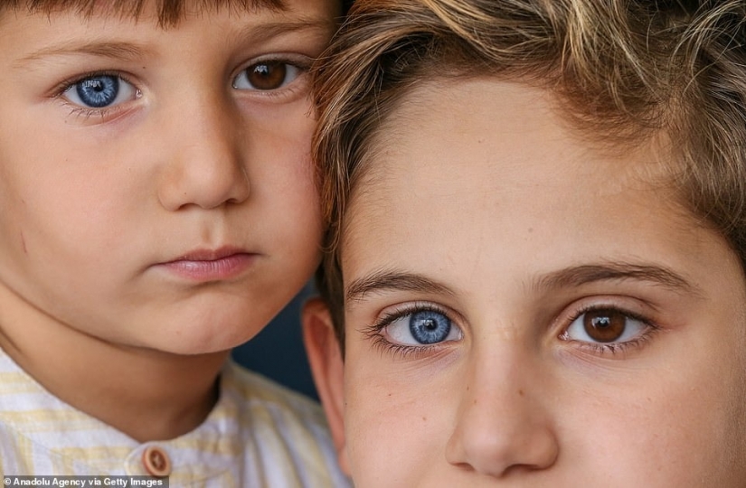 Multicolored genes: brothers from Turkey with rare heterochromia fascinate at first sight