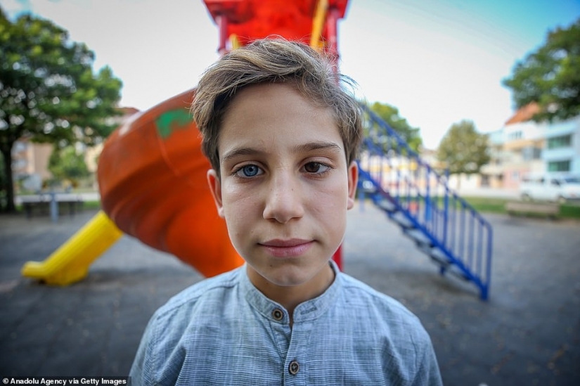 Multicolored genes: brothers from Turkey with rare heterochromia fascinate at first sight