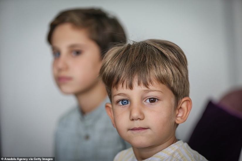 Multicolored genes: brothers from Turkey with rare heterochromia fascinate at first sight