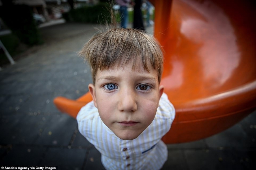 Multicolored genes: brothers from Turkey with rare heterochromia fascinate at first sight