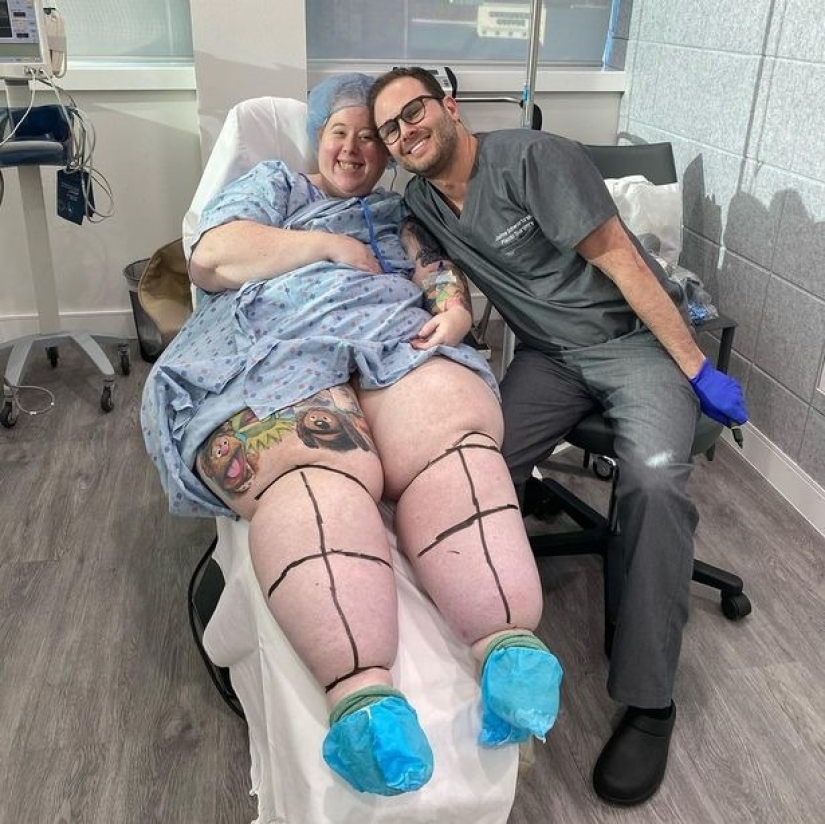 Not overeating, but a disease: an American woman is struggling with lipedema with the help of operations