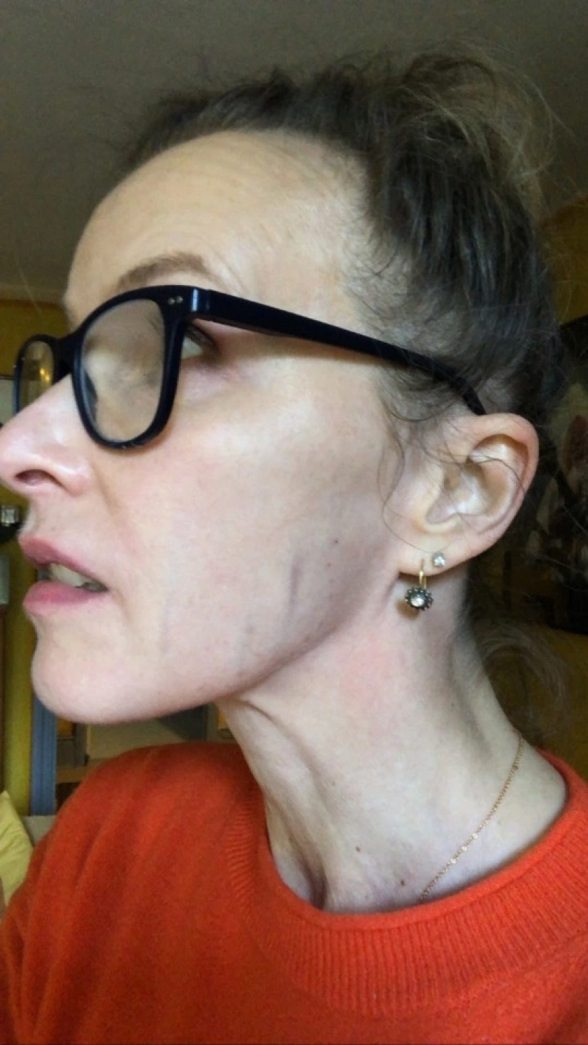 On her own skin: the British woman experienced the effects of fashionable cosmetic procedures