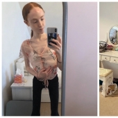 On the edge of the abyss: how a young Scottish woman weighing 25 kg was able to overcome anorexia