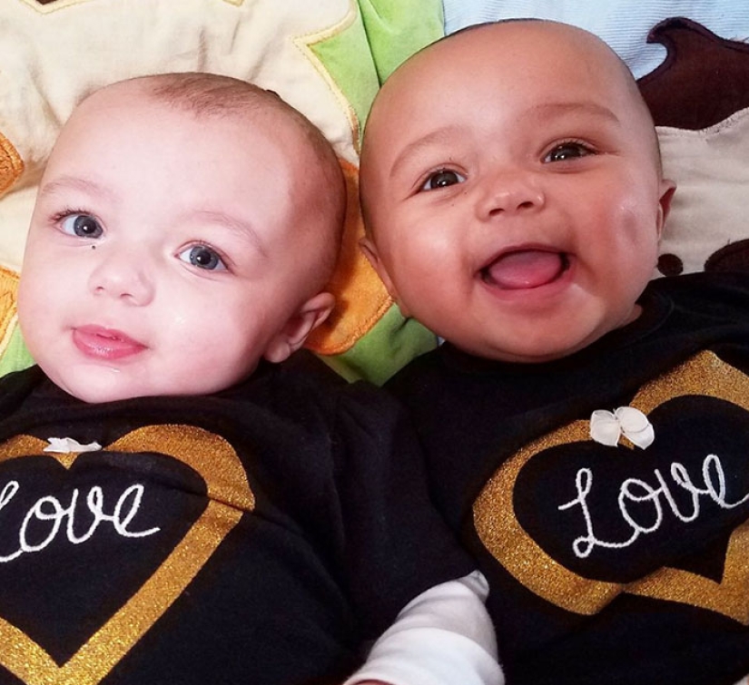 One is white, the other is tanned: a rare case of twins being born with different skin colors