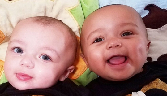 One is white, the other is tanned: a rare case of twins being born with different skin colors