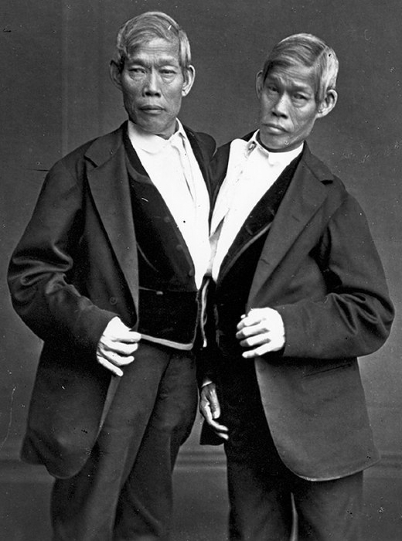 One life for two people without strain and tragedies: a happy Siamese twins