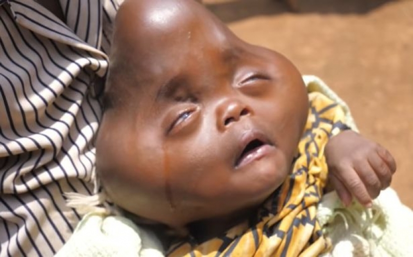 Relatives refused an African woman who gave birth to a baby with a head in the shape of a pear